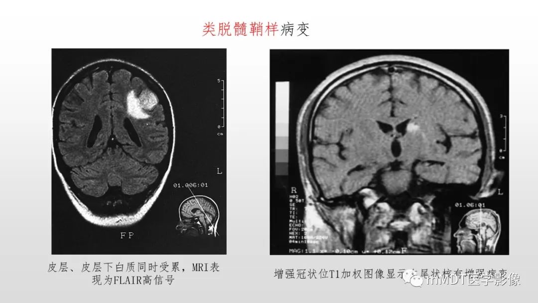 【PPT】神经白塞病NBD-37