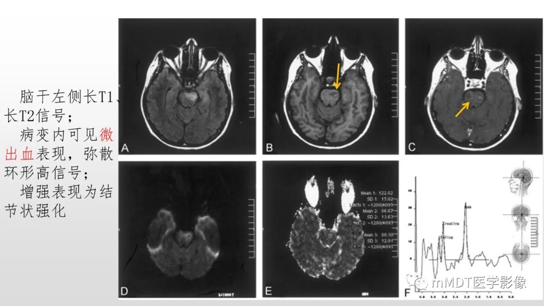 【PPT】神经白塞病NBD-38