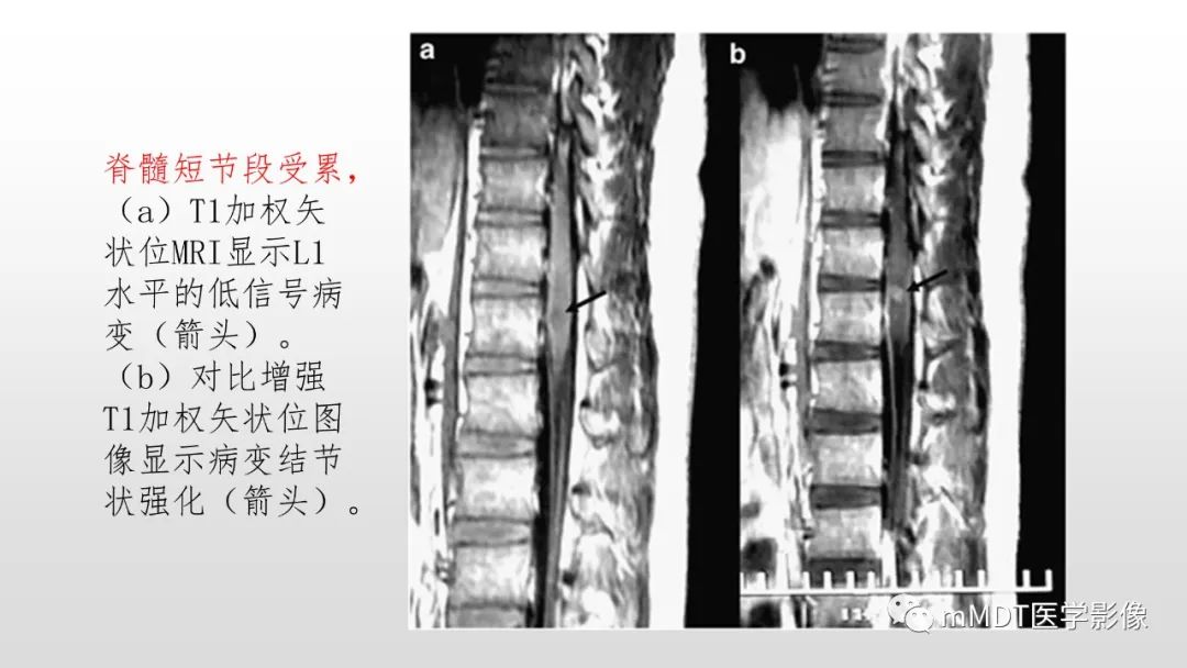 【PPT】神经白塞病NBD-39