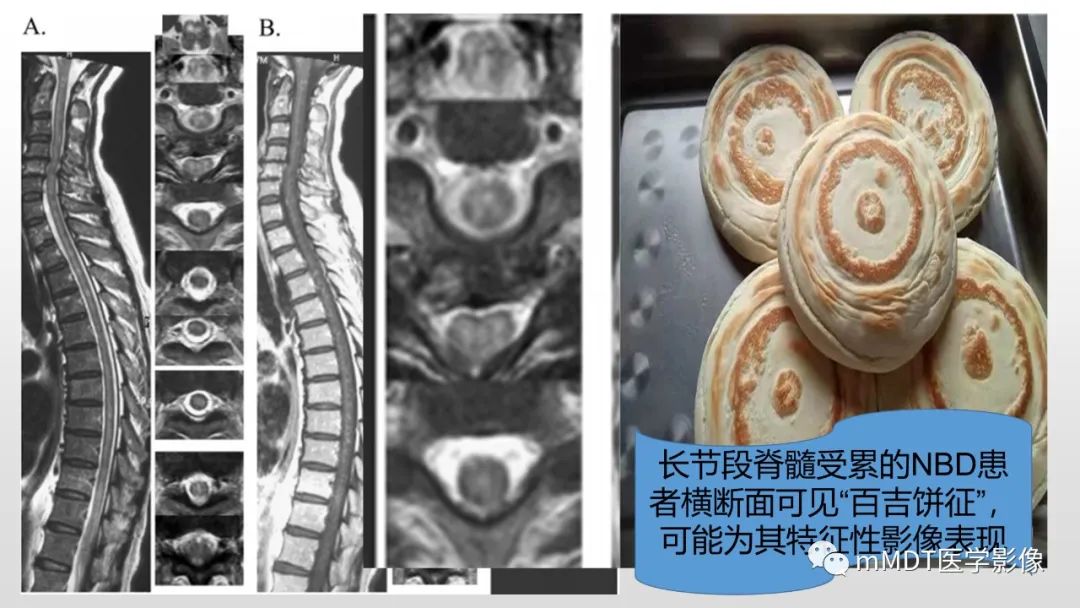 【PPT】神经白塞病NBD-41