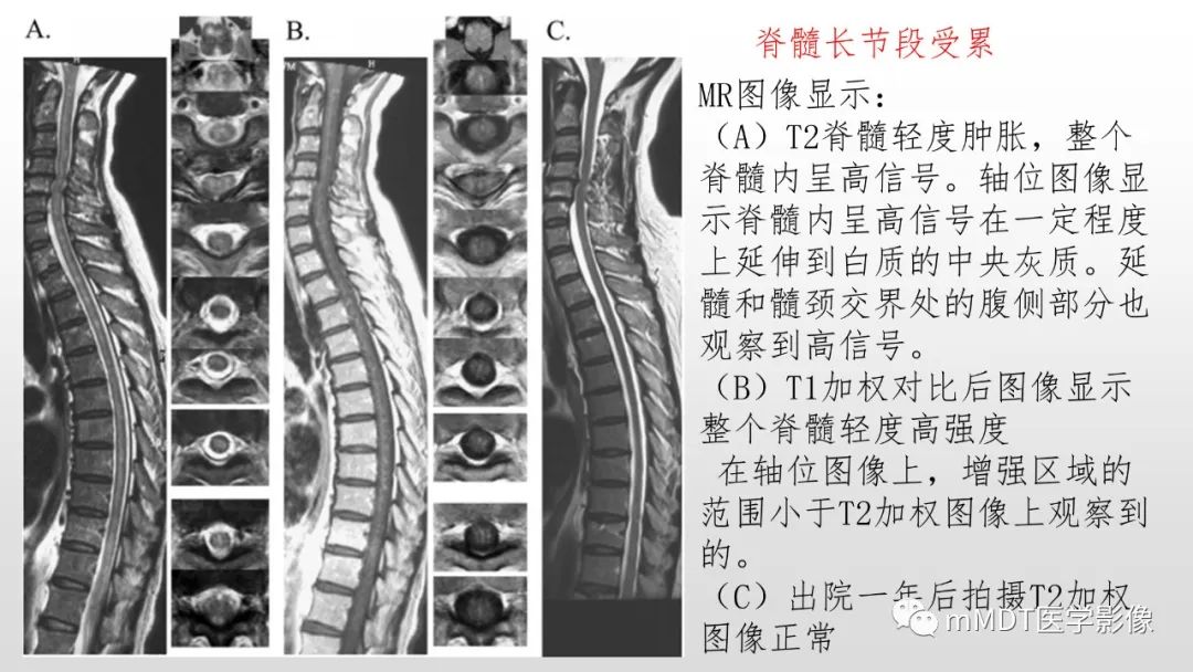 【PPT】神经白塞病NBD-40