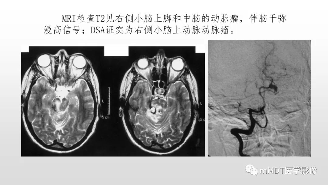 【PPT】神经白塞病NBD-42
