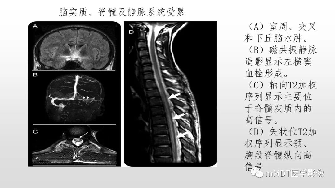 【PPT】神经白塞病NBD-43