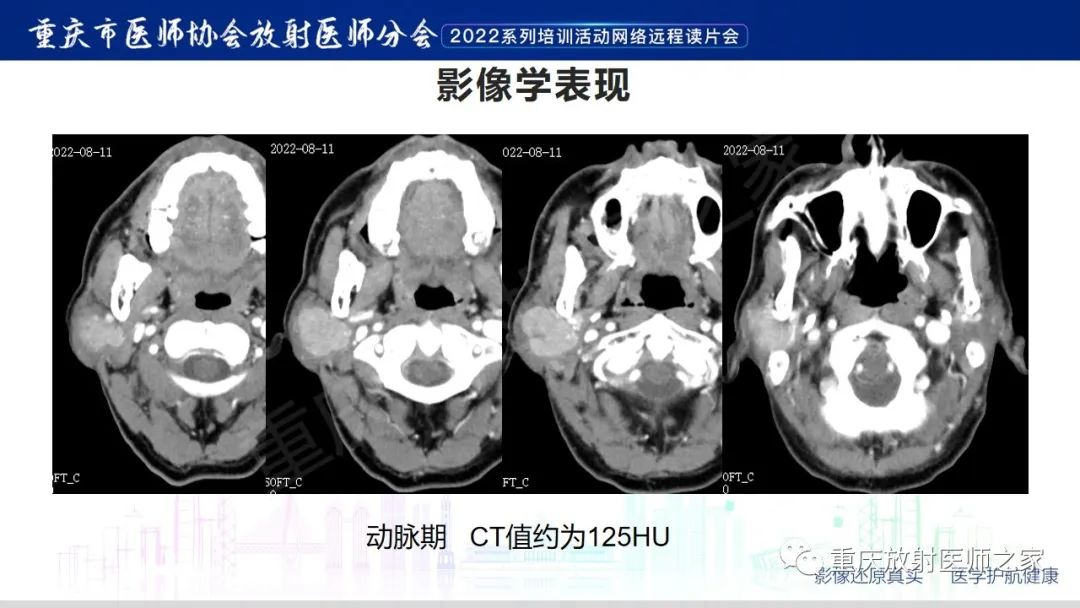 【病例】腮腺腺淋巴瘤1例CT影像-4
