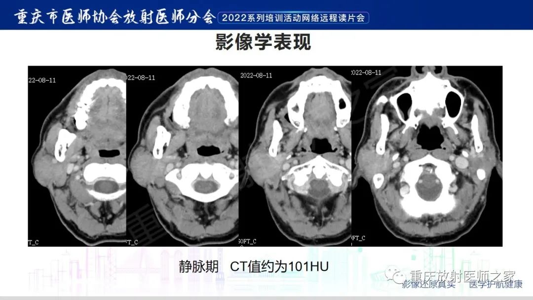 【病例】腮腺腺淋巴瘤1例CT影像-5