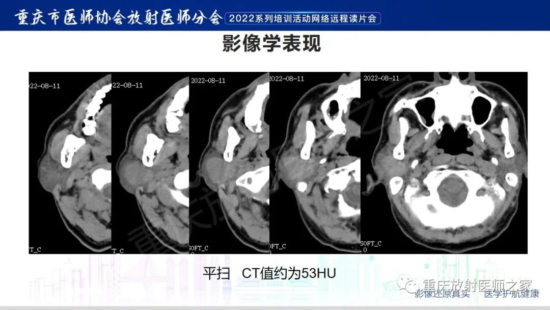 【病例】腮腺腺淋巴瘤1例CT影像-3