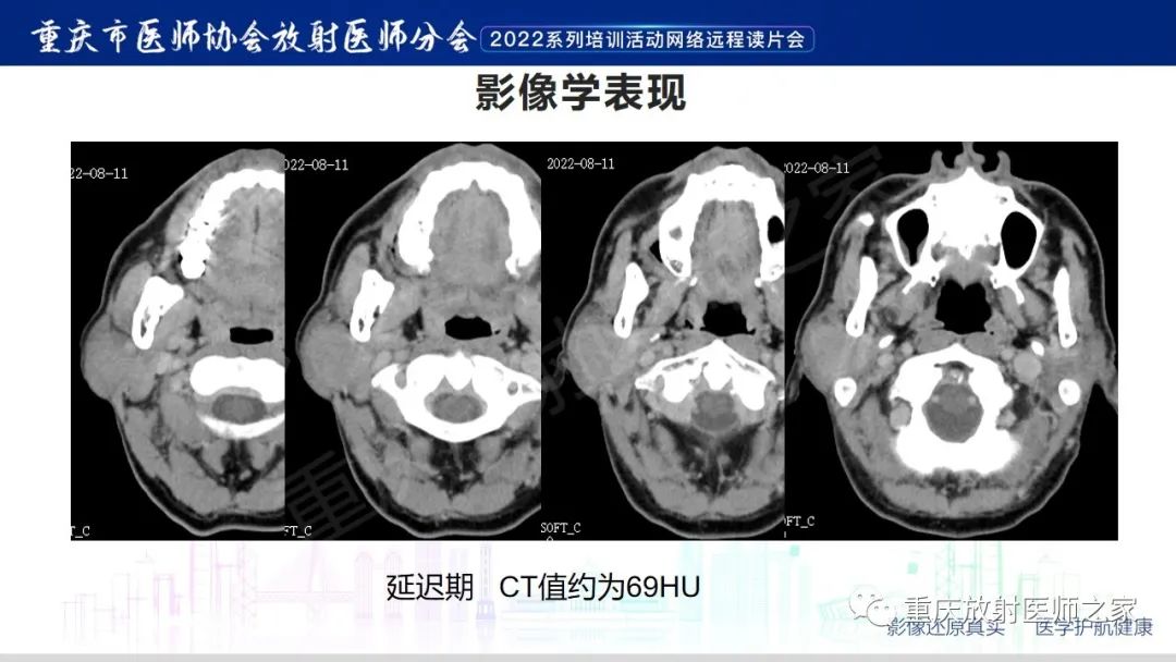 【病例】腮腺腺淋巴瘤1例CT影像-6