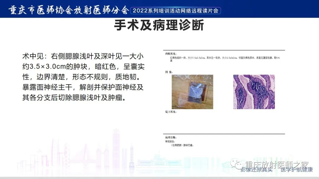 【病例】腮腺腺淋巴瘤1例CT影像-8