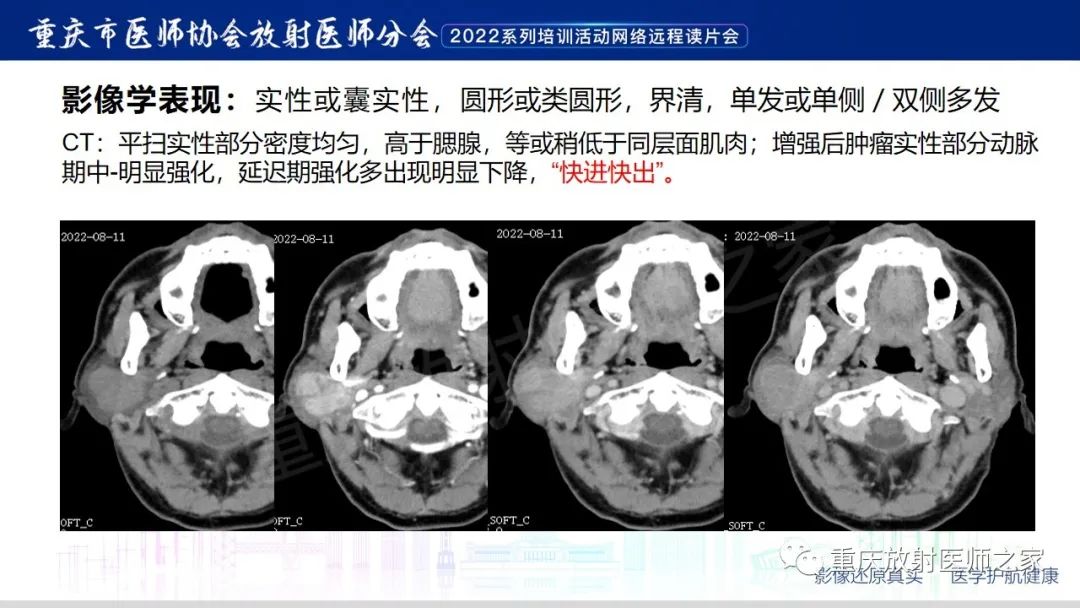 【病例】腮腺腺淋巴瘤1例CT影像-10