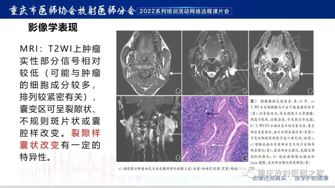 【病例】腮腺腺淋巴瘤1例CT影像-11