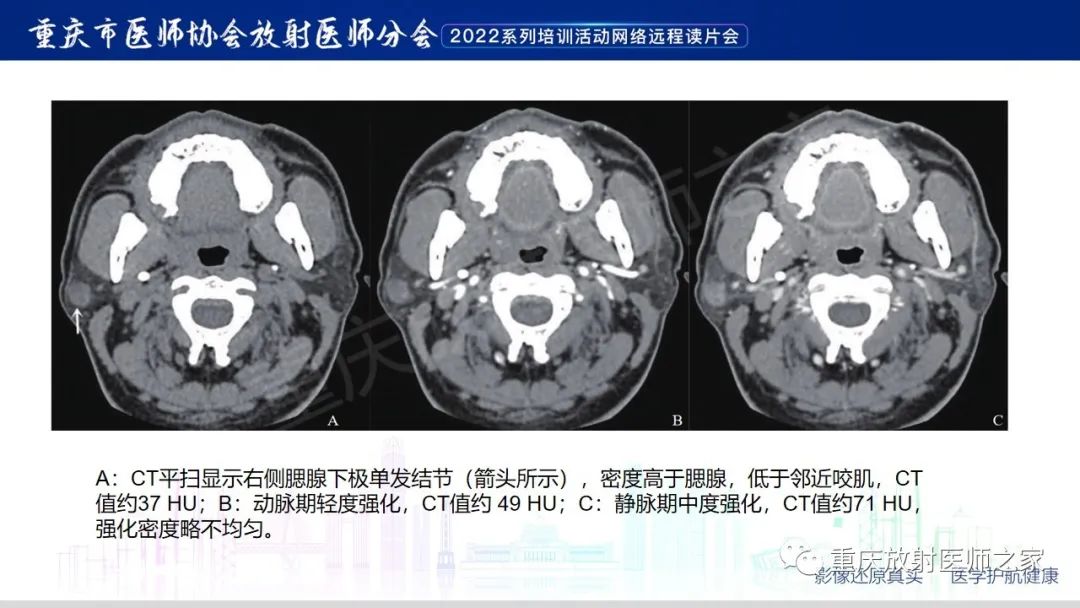 【病例】腮腺腺淋巴瘤1例CT影像-14