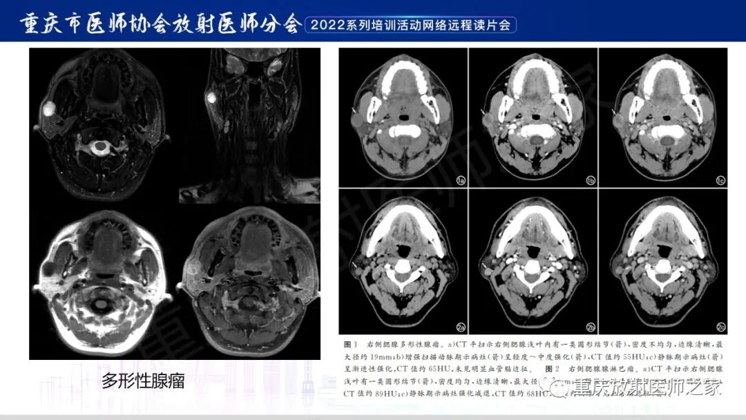 【病例】腮腺腺淋巴瘤1例CT影像-15