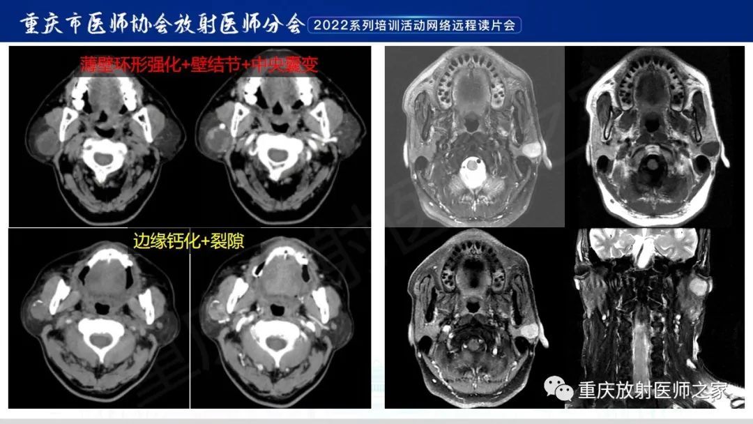 【病例】腮腺腺淋巴瘤1例CT影像-17