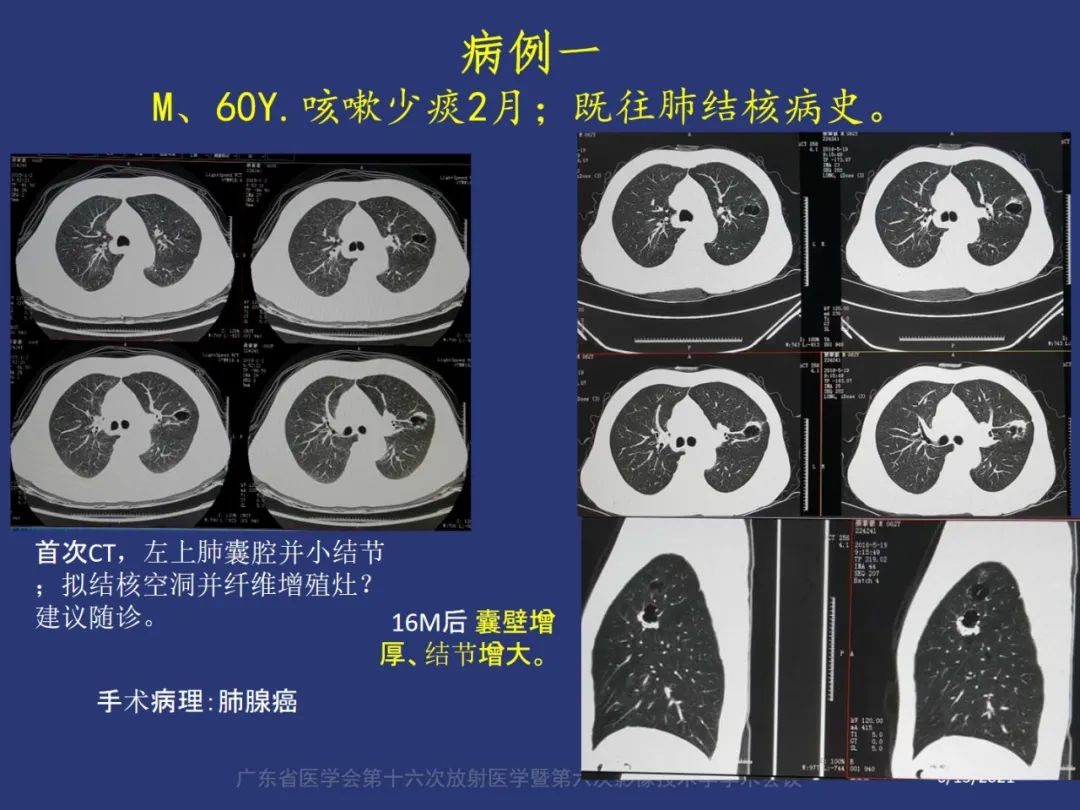 【PPT】囊腔性肺癌的影像特征和鉴别诊断-2