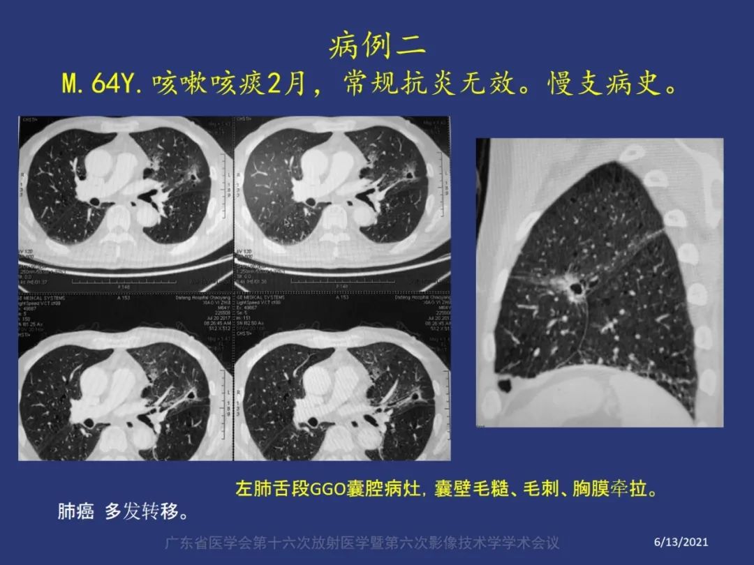 【PPT】囊腔性肺癌的影像特征和鉴别诊断-3