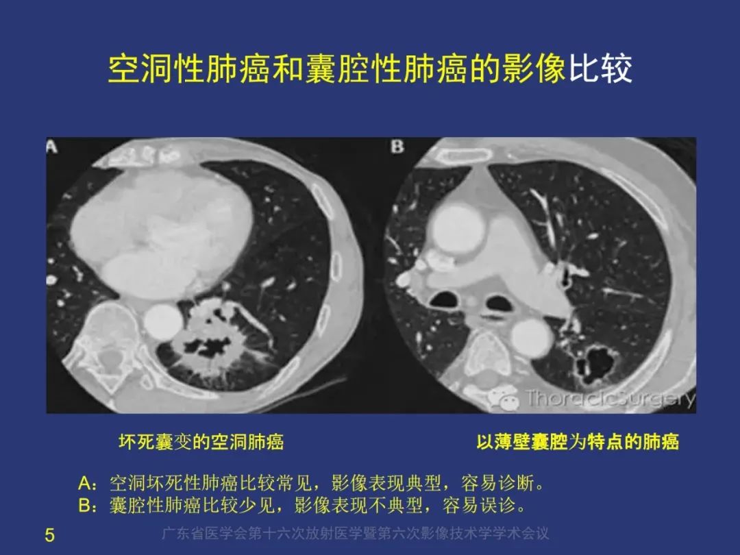 【PPT】囊腔性肺癌的影像特征和鉴别诊断-5