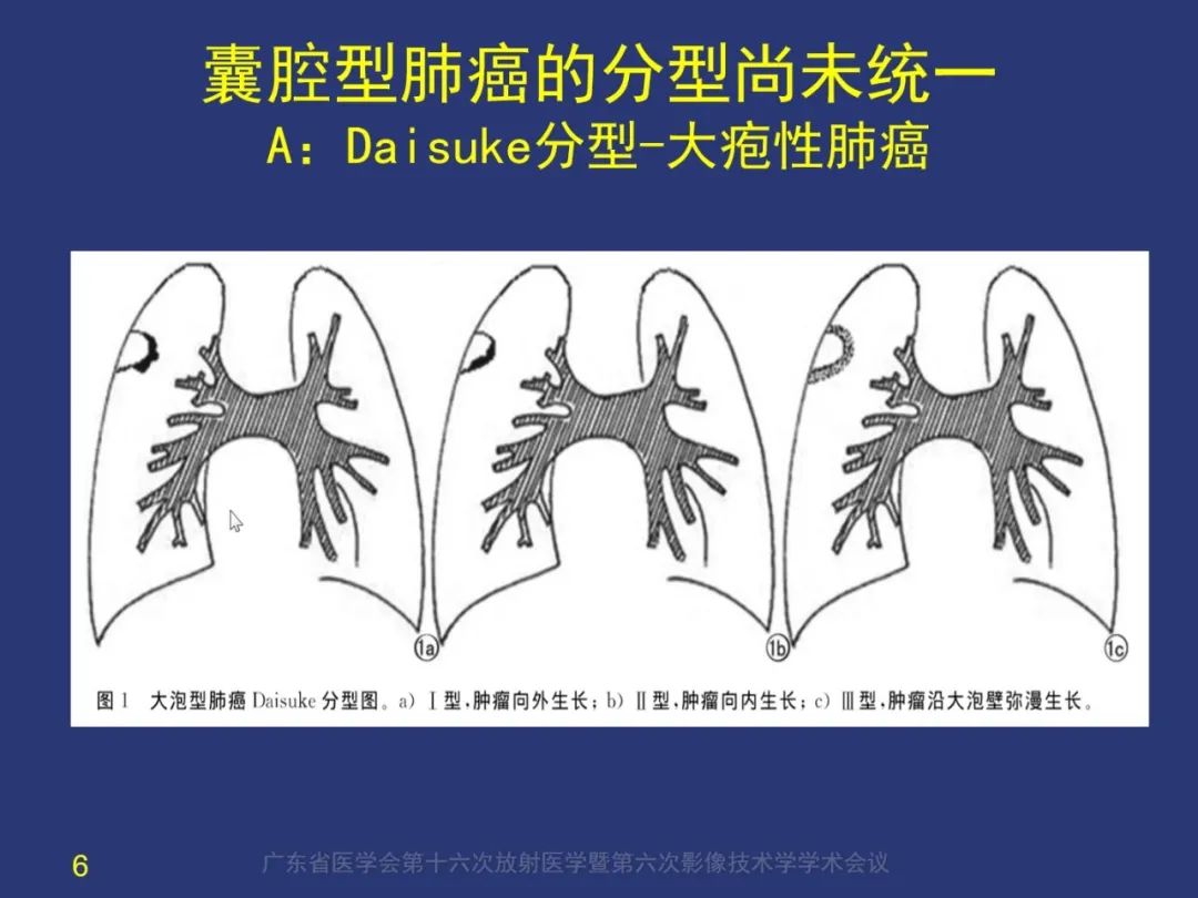 【PPT】囊腔性肺癌的影像特征和鉴别诊断-6