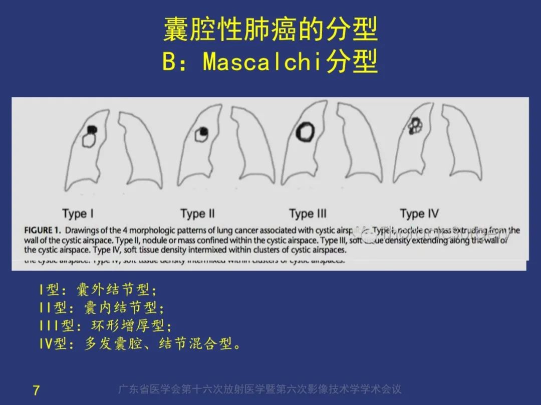 【PPT】囊腔性肺癌的影像特征和鉴别诊断-7