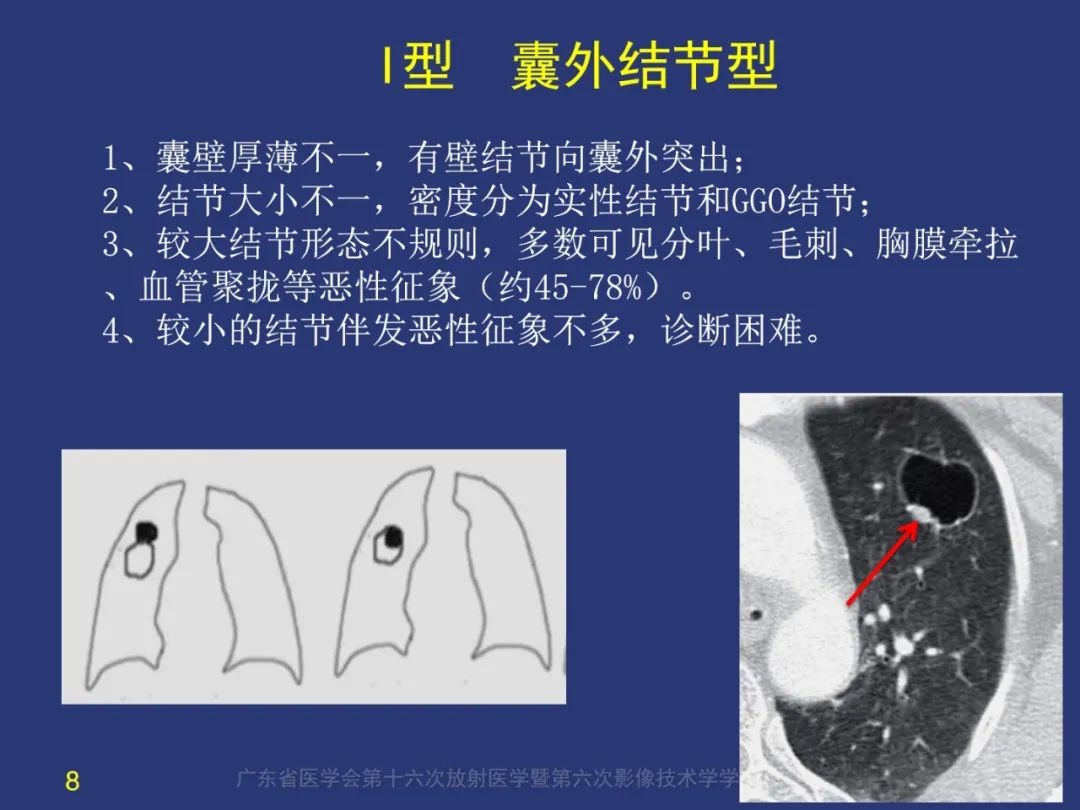 【PPT】囊腔性肺癌的影像特征和鉴别诊断-8