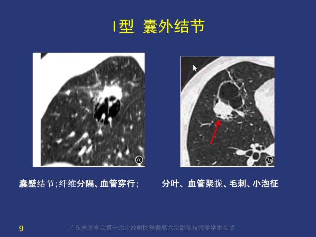 【PPT】囊腔性肺癌的影像特征和鉴别诊断-9