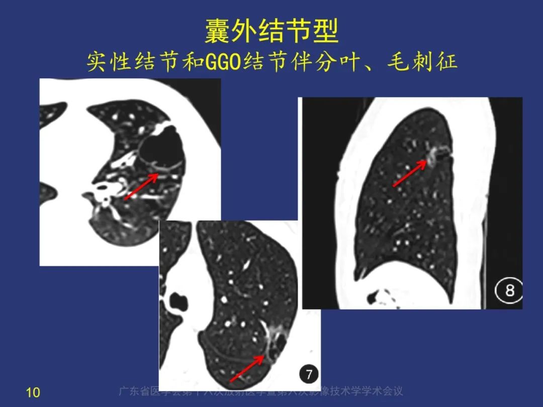 【PPT】囊腔性肺癌的影像特征和鉴别诊断-10