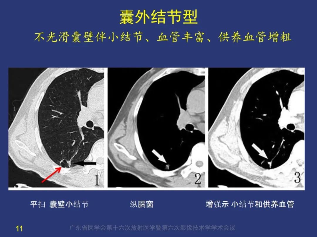 【PPT】囊腔性肺癌的影像特征和鉴别诊断-11
