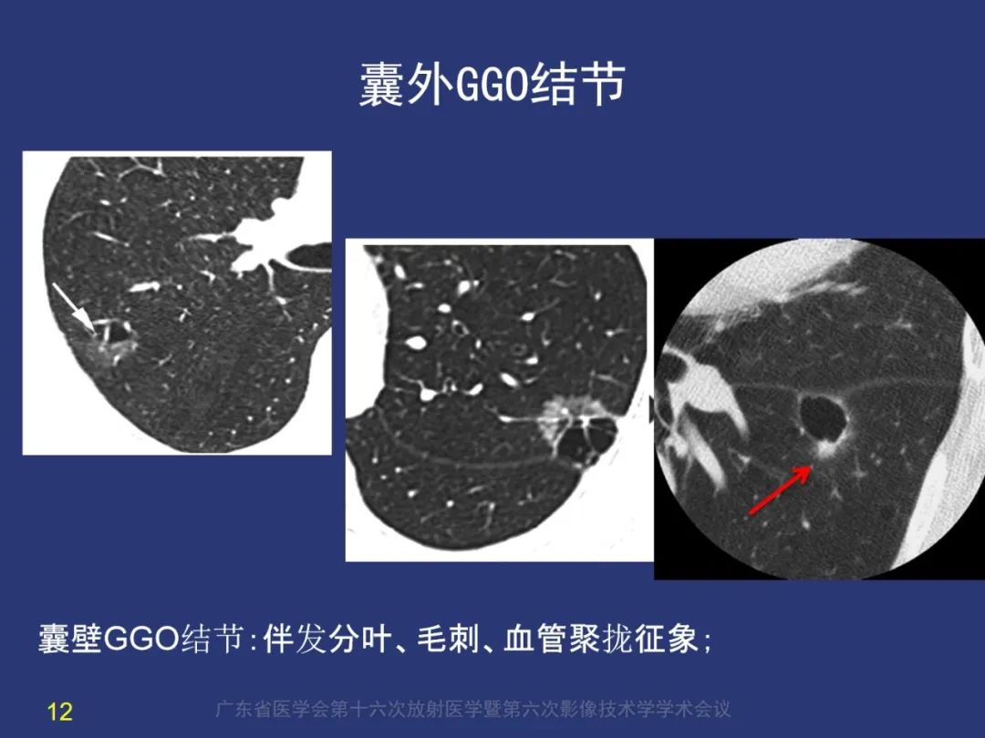 【PPT】囊腔性肺癌的影像特征和鉴别诊断-12
