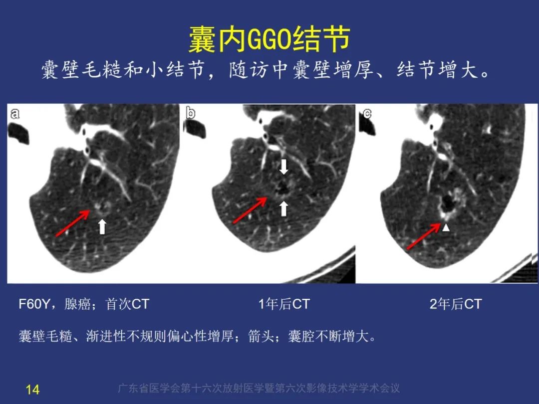 【PPT】囊腔性肺癌的影像特征和鉴别诊断-14