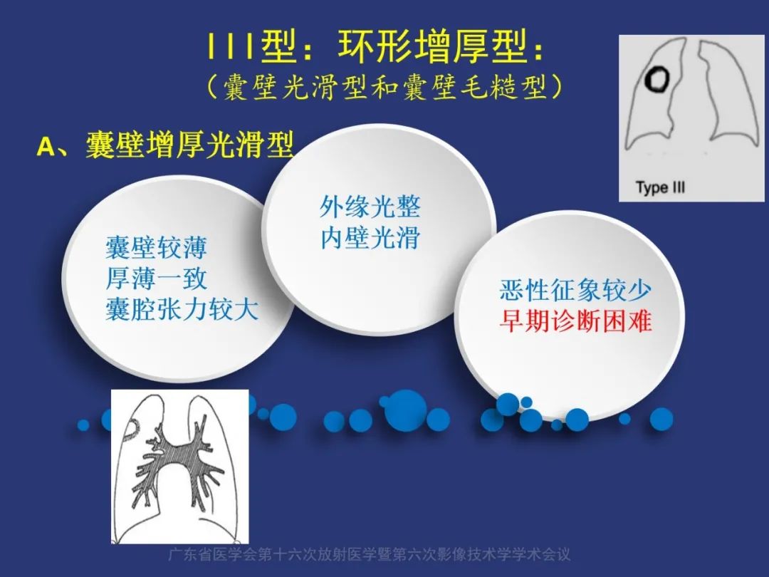 【PPT】囊腔性肺癌的影像特征和鉴别诊断-15