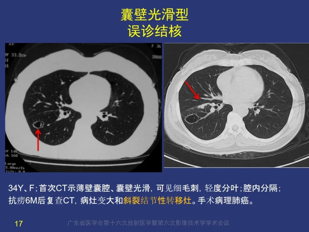 【PPT】囊腔性肺癌的影像特征和鉴别诊断-17