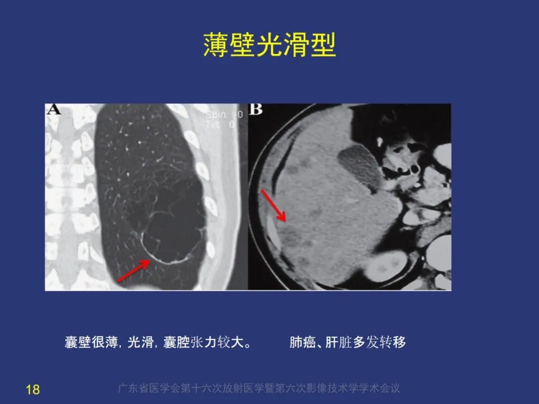 【PPT】囊腔性肺癌的影像特征和鉴别诊断-18