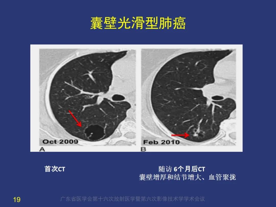 【PPT】囊腔性肺癌的影像特征和鉴别诊断-19