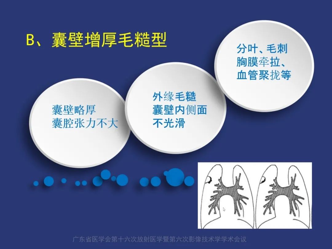 【PPT】囊腔性肺癌的影像特征和鉴别诊断-20