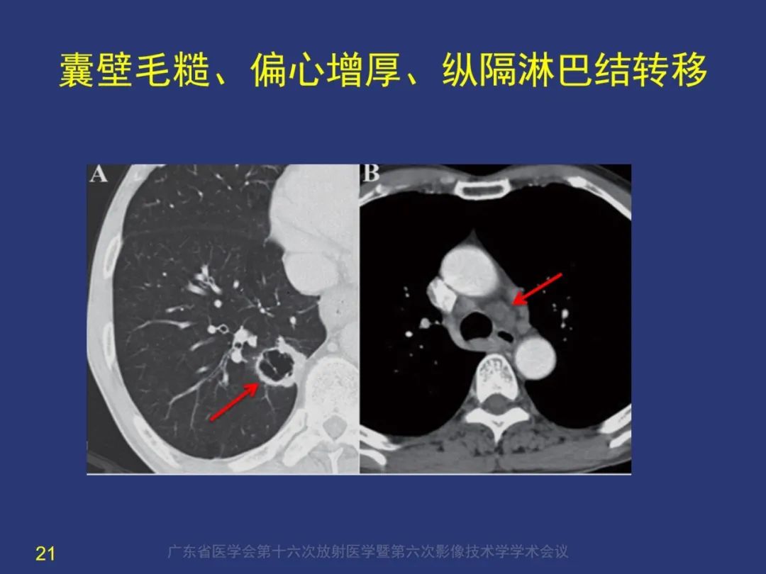 【PPT】囊腔性肺癌的影像特征和鉴别诊断-21