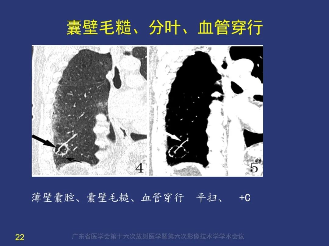 【PPT】囊腔性肺癌的影像特征和鉴别诊断-22