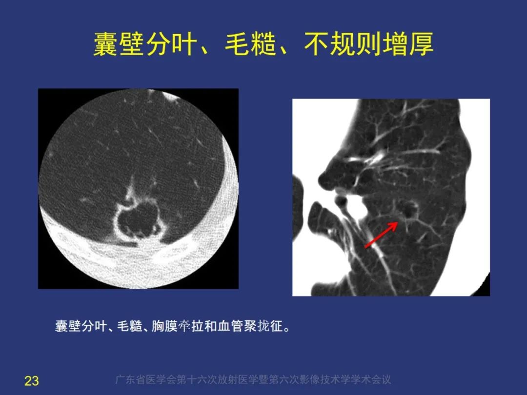 【PPT】囊腔性肺癌的影像特征和鉴别诊断-23