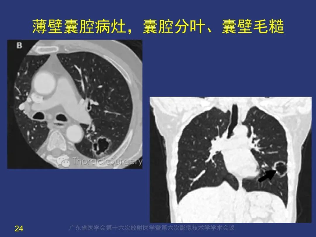 【PPT】囊腔性肺癌的影像特征和鉴别诊断-24