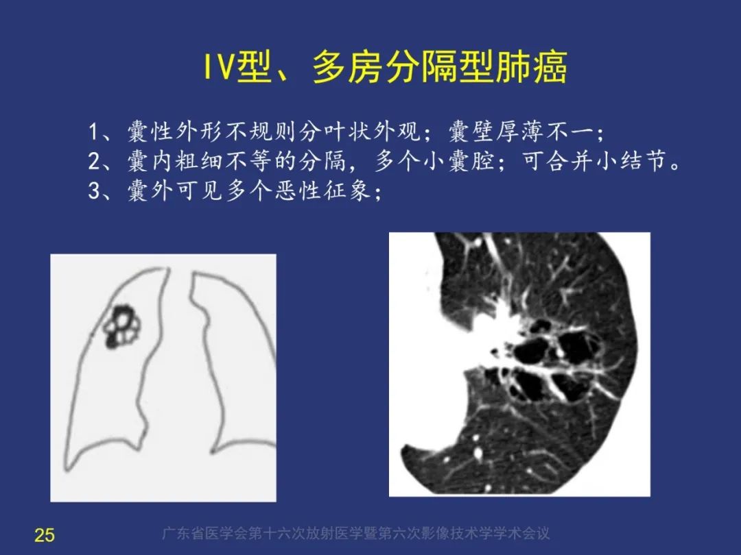 【PPT】囊腔性肺癌的影像特征和鉴别诊断-25
