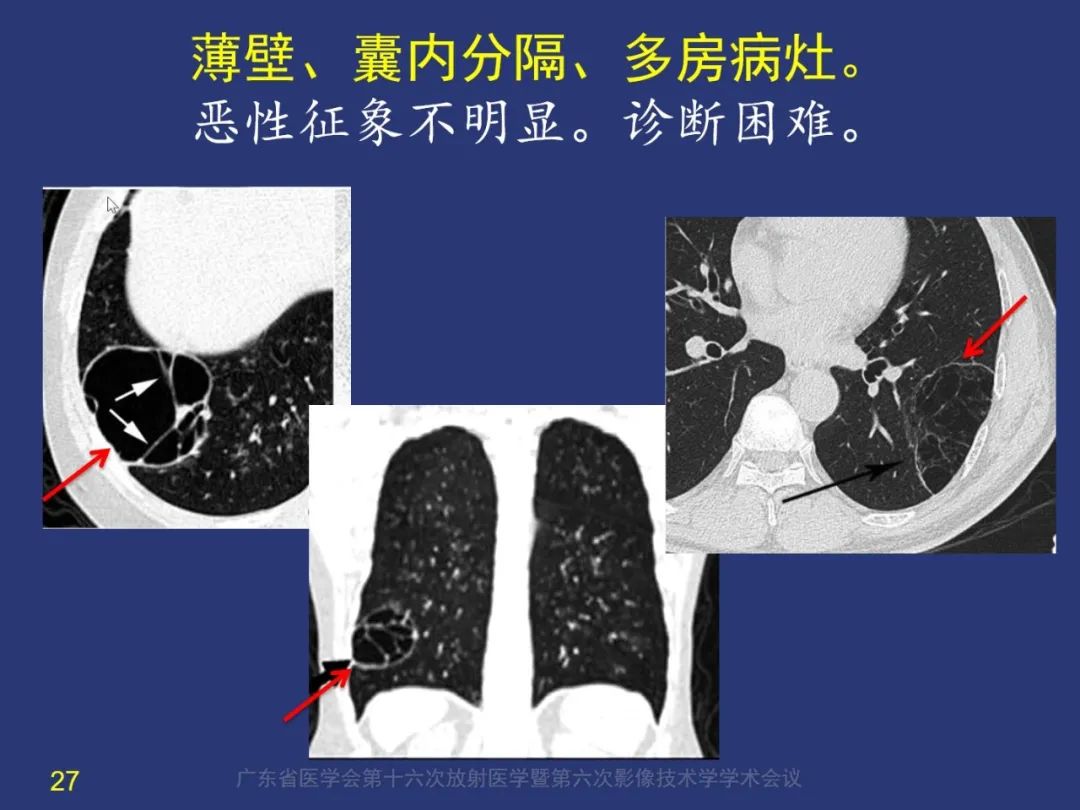 【PPT】囊腔性肺癌的影像特征和鉴别诊断-27