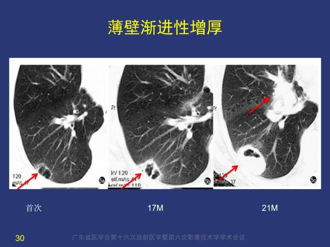 【PPT】囊腔性肺癌的影像特征和鉴别诊断-30