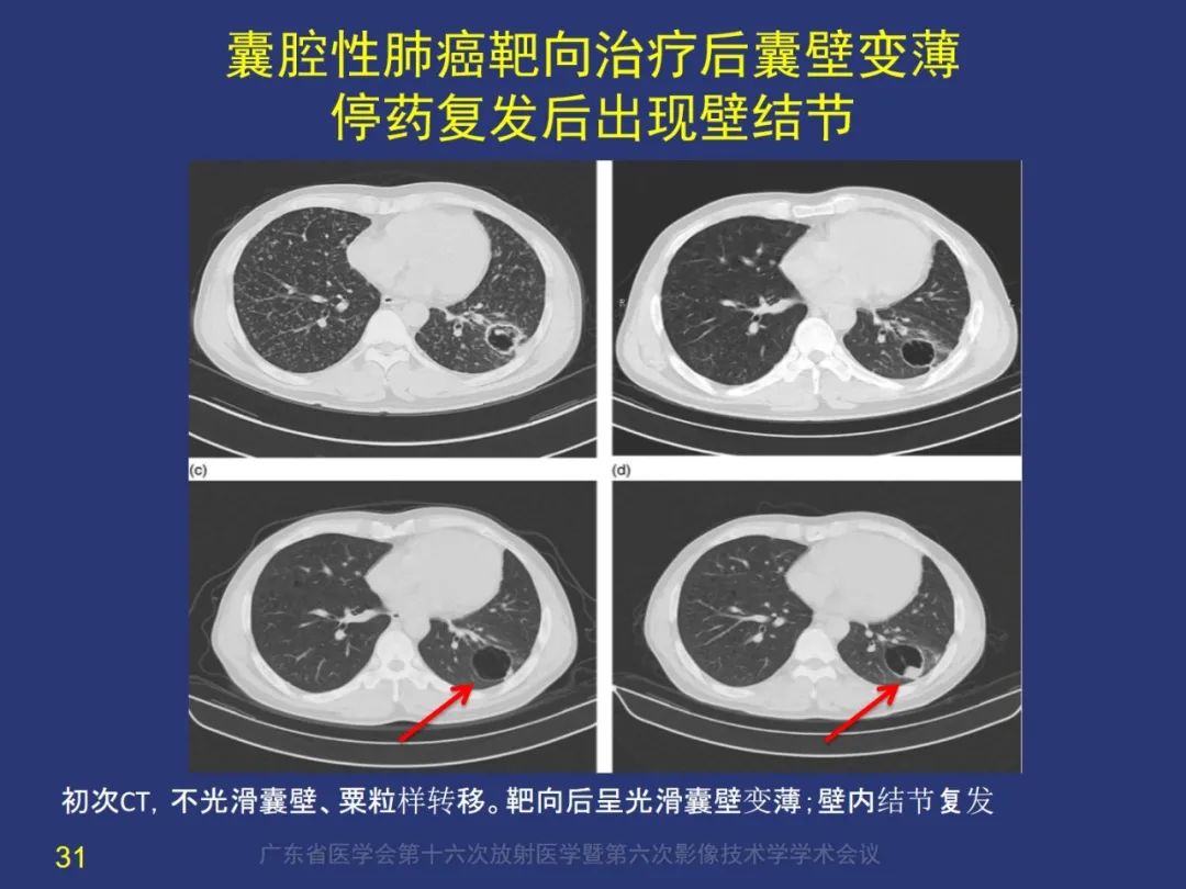 【PPT】囊腔性肺癌的影像特征和鉴别诊断-31