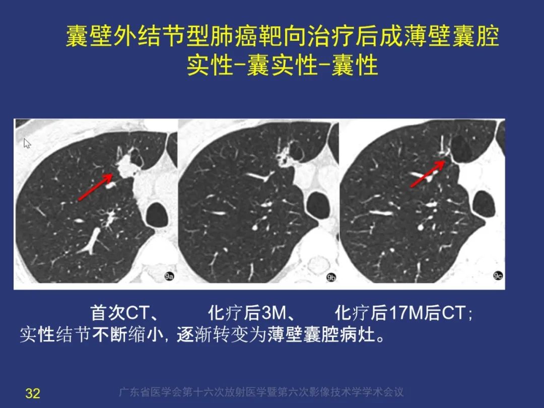 【PPT】囊腔性肺癌的影像特征和鉴别诊断-32