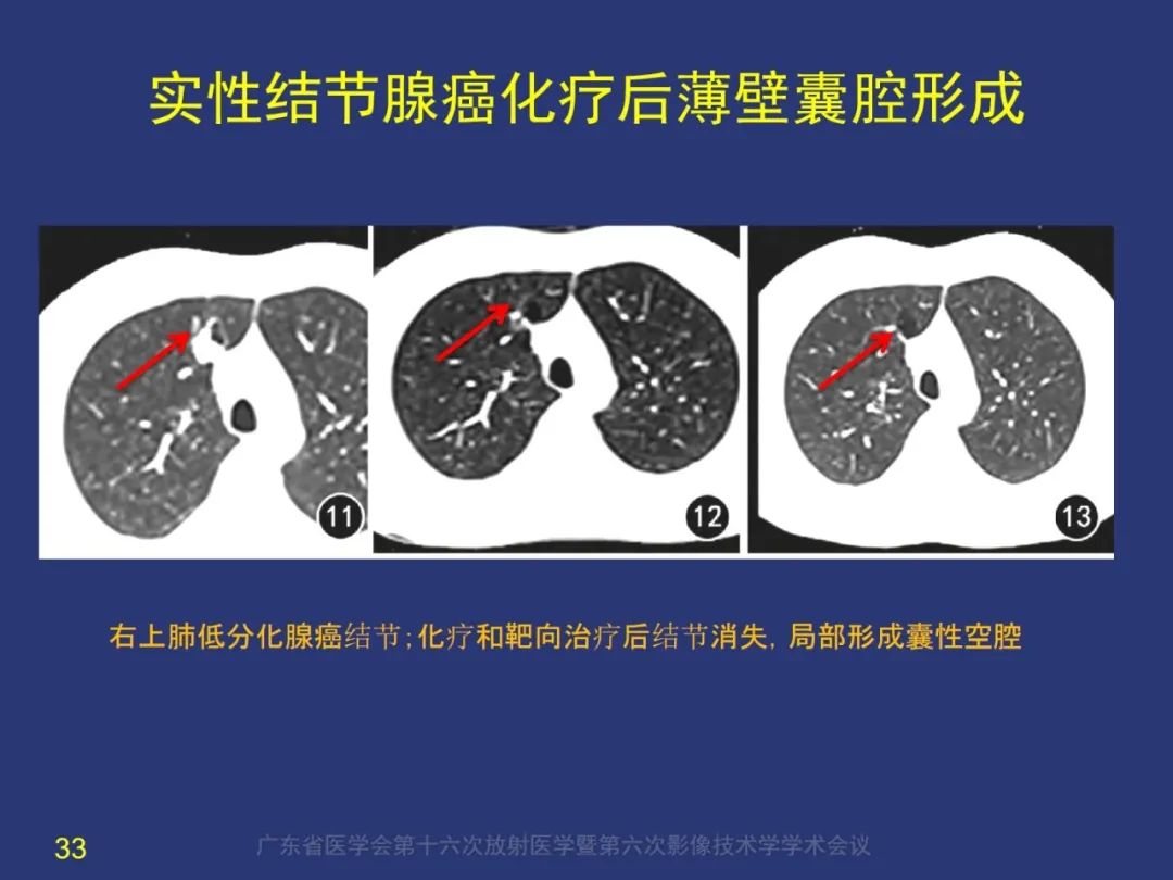 【PPT】囊腔性肺癌的影像特征和鉴别诊断-33