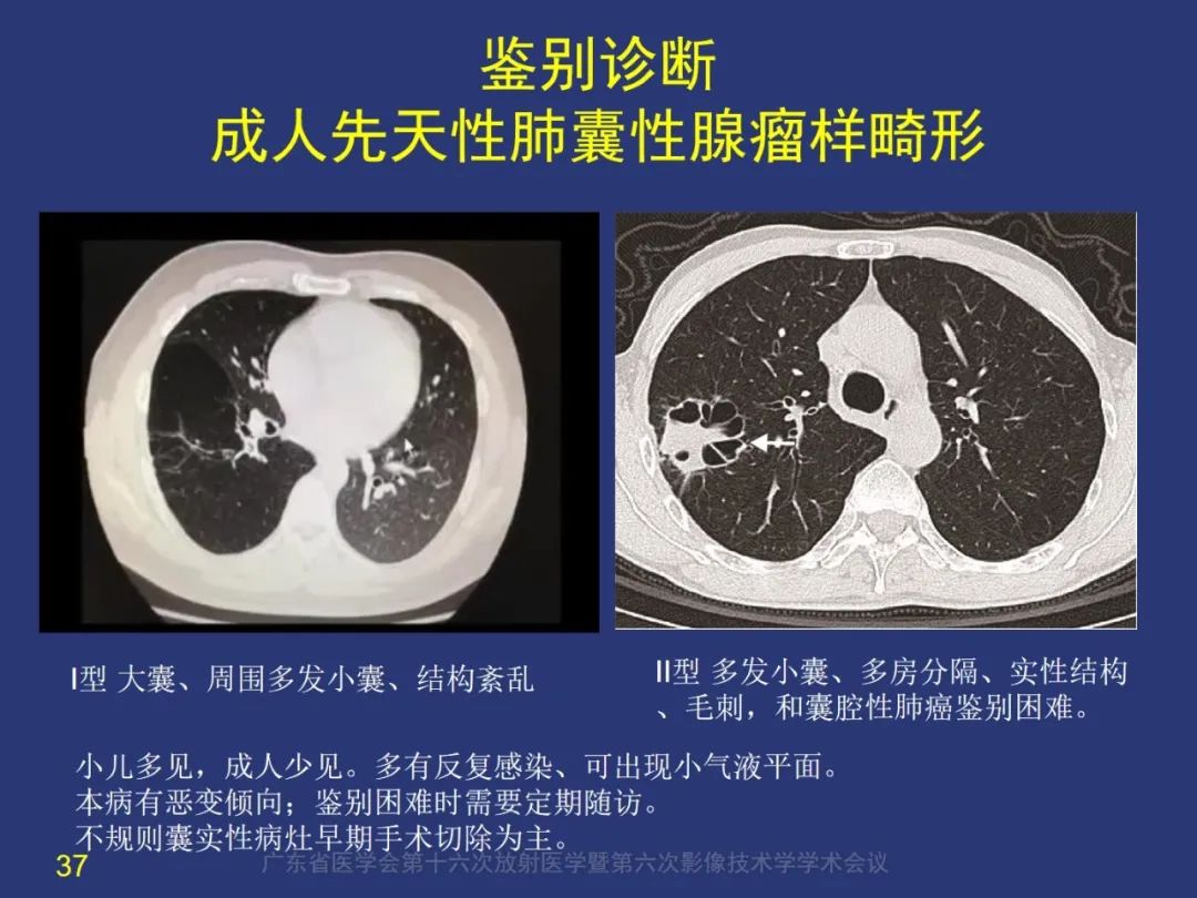 【PPT】囊腔性肺癌的影像特征和鉴别诊断-37