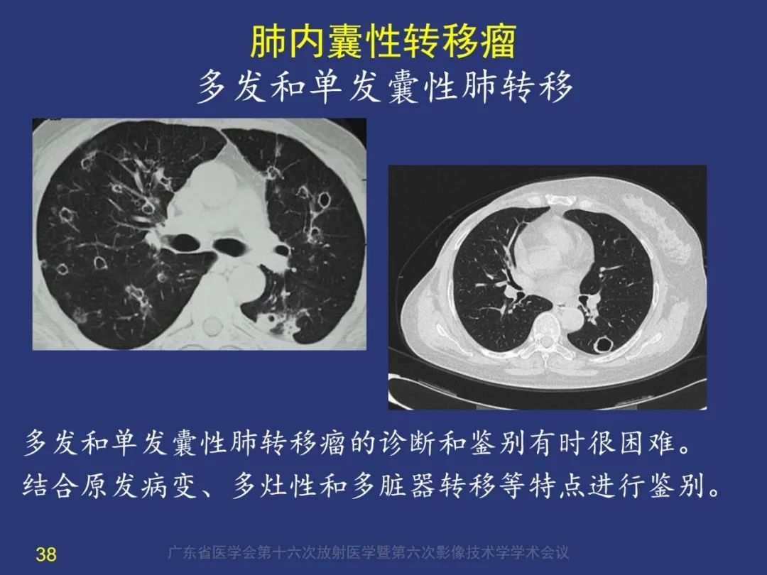 【PPT】囊腔性肺癌的影像特征和鉴别诊断-38