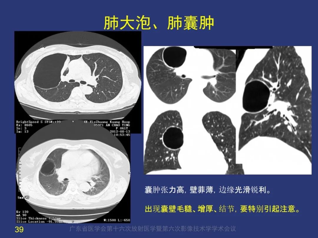 【PPT】囊腔性肺癌的影像特征和鉴别诊断-39