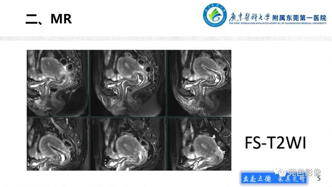 【病例】不全流产1例超声及MR影像-5