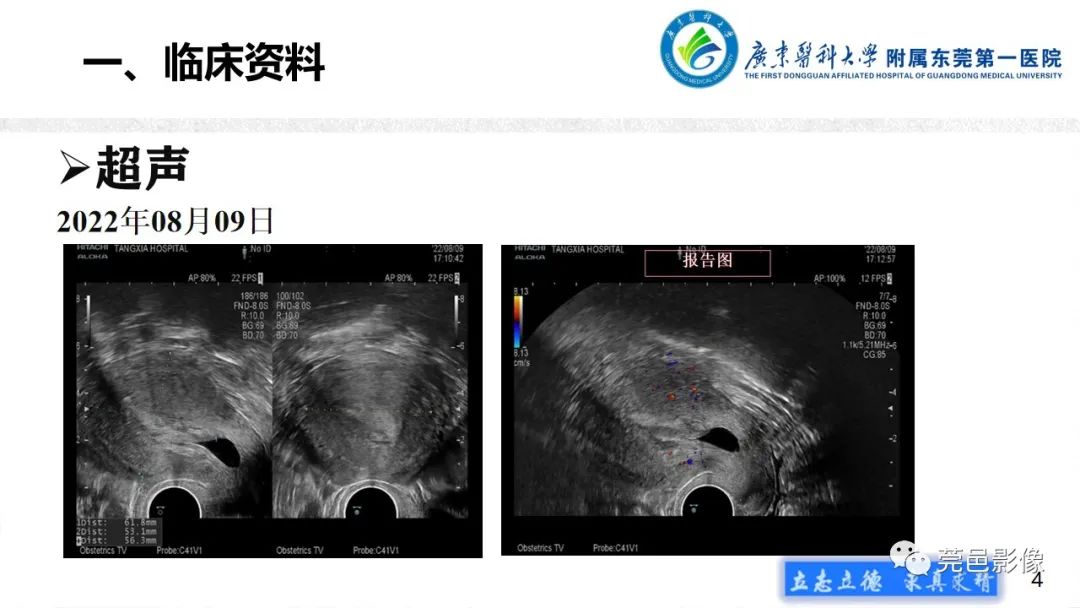 【病例】不全流产1例超声及MR影像-4