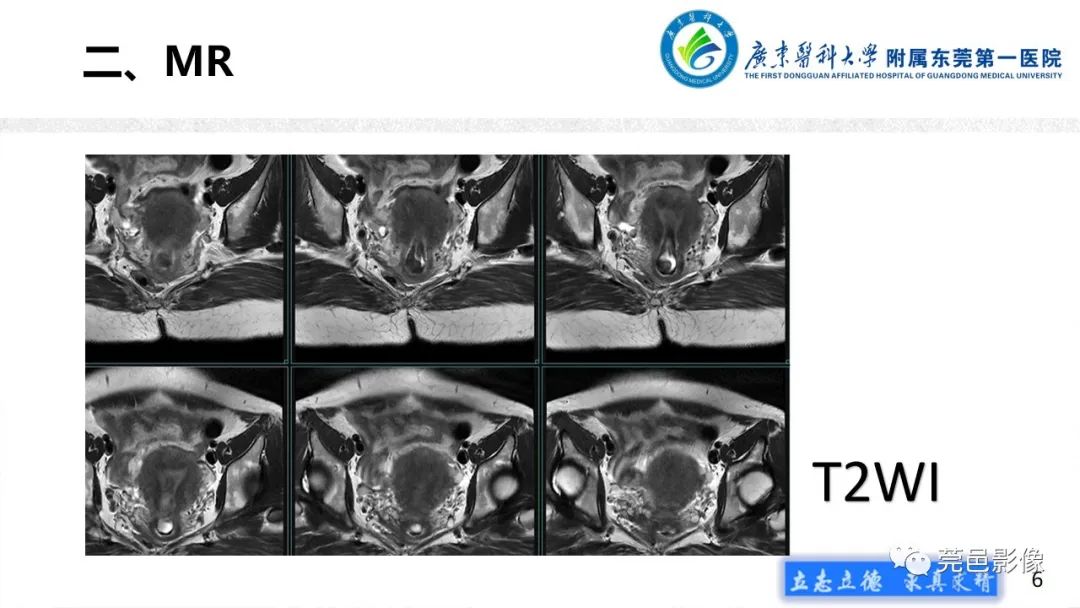 【病例】不全流产1例超声及MR影像-6