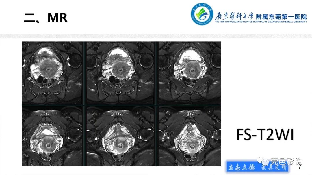 【病例】不全流产1例超声及MR影像-7